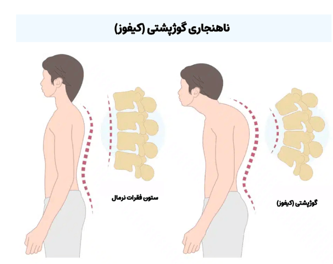 حرکات اصلاحی قوز پشت