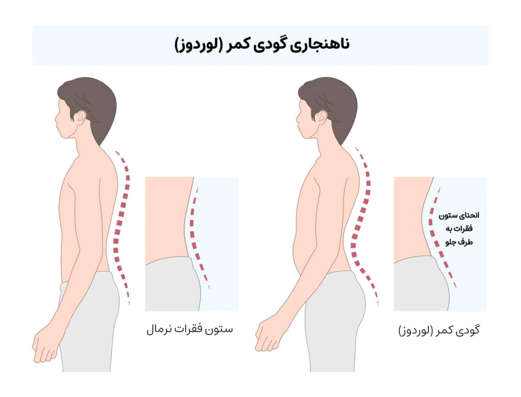 گودی کمر یا لوردوز 