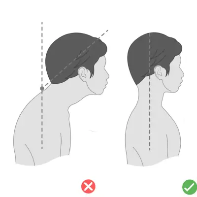 گردن به جلو (Forward Head Posture)