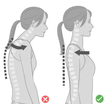 شانه‌های افتاده یا گرد (Rounded Shoulders)
